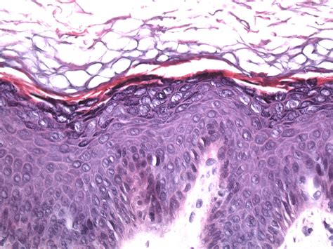 Epidermodysplasia Verruciformis Histology