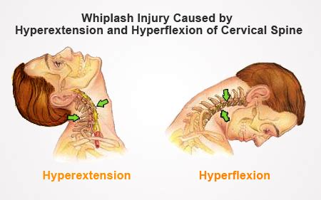 Whiplash Injury | Rehab Basics