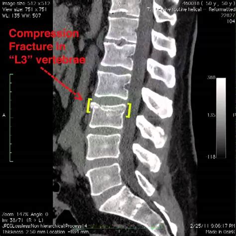 Stress Fracture Back Recovery Time at Bryan Soto blog