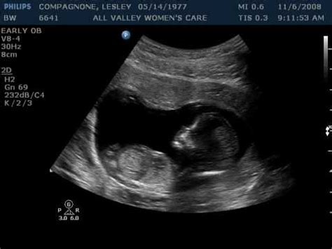 Three Month Ultrasound - YouTube