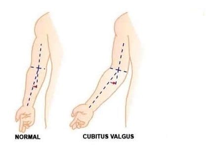 Cubitus valgus : Cause, Type, symptoms, Physiotherapy Treatment