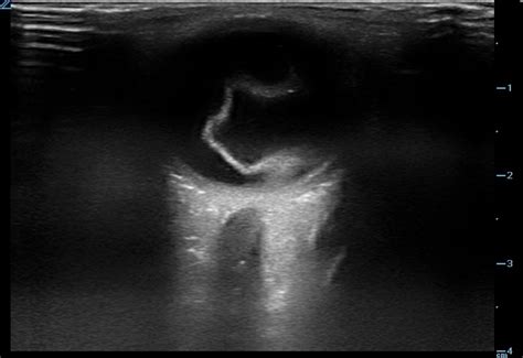 Retinal Detachment Ultrasound