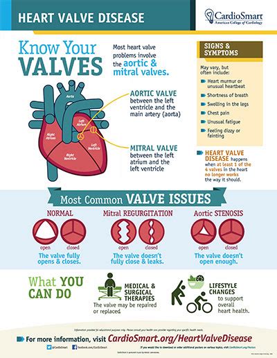 Mitral Regurgitation | CardioSmart – American College of Cardiology