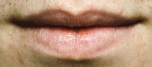 Lip Cancer: Not Uncommon, Often Overlooked - ChopSaver