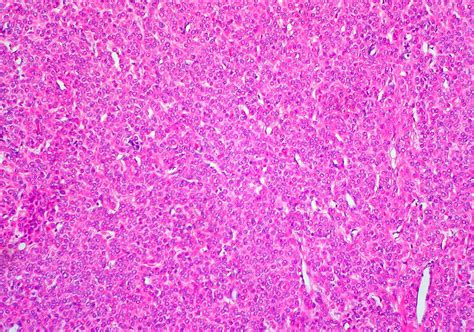 Epithelioid Leiomyoma of Uterine Corpus