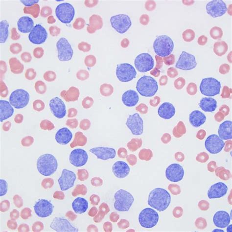 The peripheral blood smear showed marked leukocytosis with... | Download Scientific Diagram