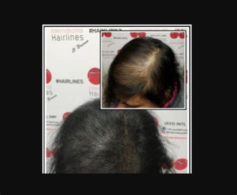 Female Pattern Baldness — What is the Best Treatment for It?