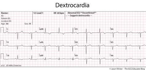 ECG Educator Blog : Dextrocardia