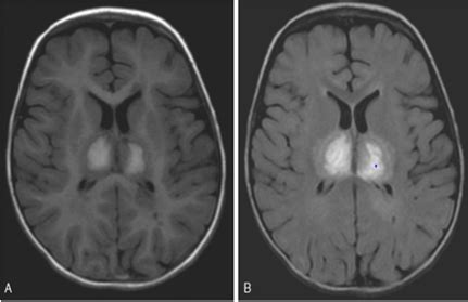 abnormal mri brain “Acute Necrotizing Encephalitis” - Radiology Imaging