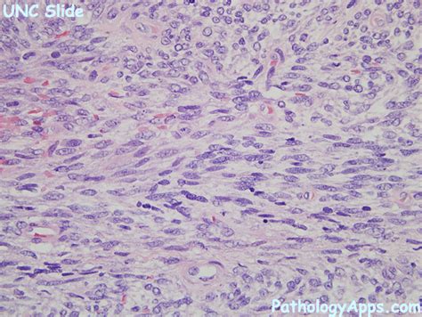 synovial sarcoma pathology