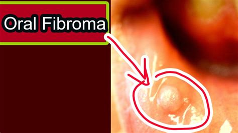 Fibroma