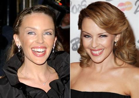 Kylie Minogue News and facts about plastic surgery!