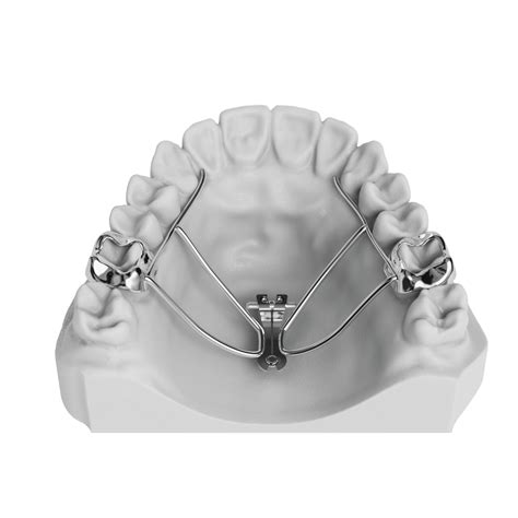 Fan RPE (Rapid Palatal Expander) | ODL Orthodontic Labs