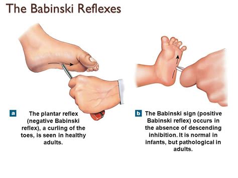 The Babinski Reflex in Infants and Adults