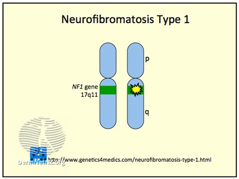 NF1 Associated with More Cancer Types Than Previously Known - NCI