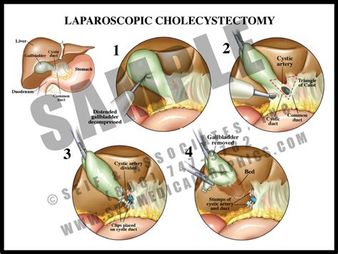 Adhesions - S&A Medical Graphics