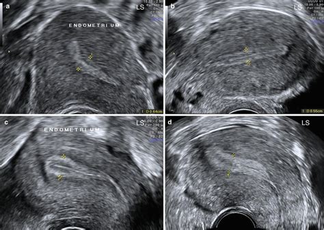 Endometrial Phases Ultrasound