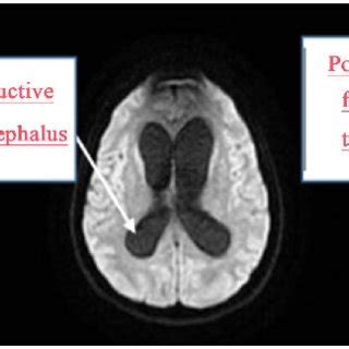 MRI shows intra-axial cerebellar lesion (4.9 × 4.3 × 4.0 cm) involves... | Download Scientific ...