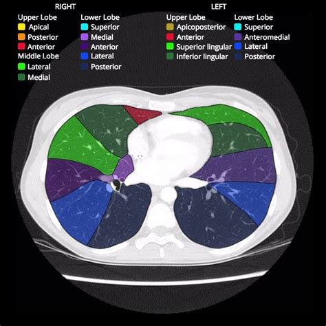 Bronchopulmonary segments: annotated CT | Radiology Case | Radiopaedia.org