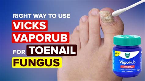 The Right Way To Use Vicks Vaporub for Toenail Fungus - Toenail Fungus Cure - YouTube