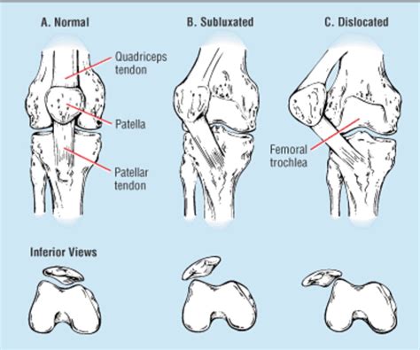 Lateral Knee Subluxation — CoreFitChicago