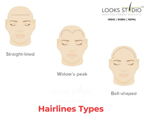 Discover the Different Hairlines Types and How to Achieve Your Desired Look - Hair Transplant ...