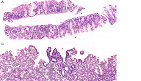 A, Overview of sessile serrated adenoma/sessile serrated lesion with... | Download Scientific ...