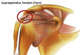 supraspinatus tendon tear | All about Backs etc.! | Supraspinatus tendon tear, Tendon tear ...