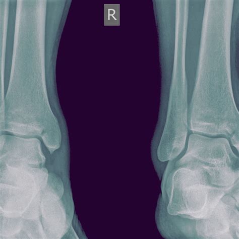 Medial Malleolus Pain When Walking / Ankle Human Anatomy Image Function Conditions More : Even ...