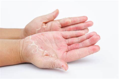 The Dry Hands, Peel, Contact Dermatitis, Fungal Infections, Skin Inf Stock Image - Image of ...