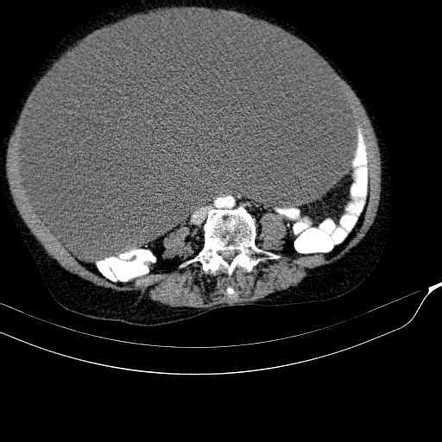 Giant mesenteric cyst | Radiology Case | Radiopaedia.org