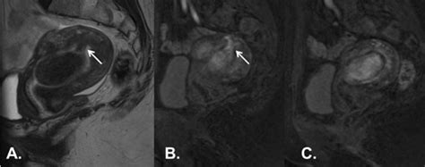 Caracterización de mioma submucoso en RM. Cortes sagitales de RM de... | Download Scientific Diagram