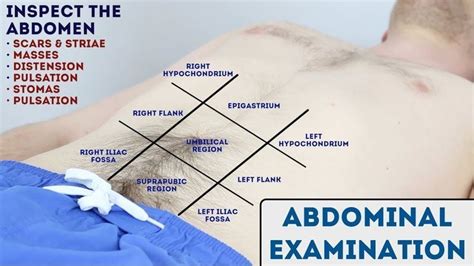 Abdominal Examination - OSCE Guide (New Release) - YouTube | Abdominal, Free medical, Medical