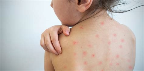 Measles Symptoms: Six Symptoms to Watch out For