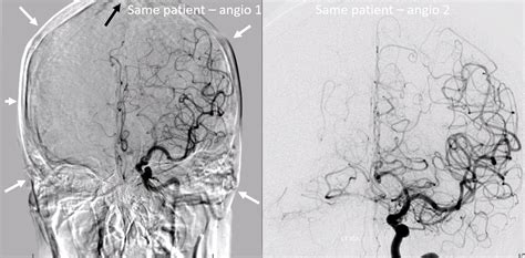 The Art of Cerebral Angiography | neuroangio.org