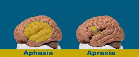 Archives | The Aphasia Center