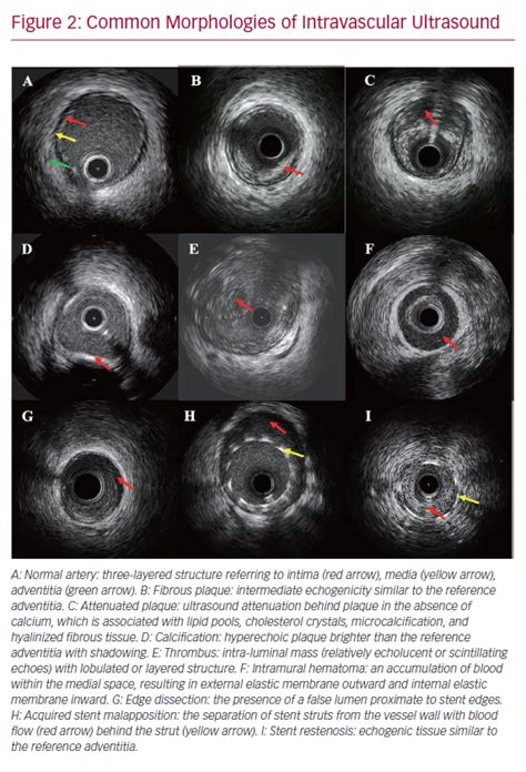 Common Morphologies of Intravascular Ultrasound | Radcliffe Cardiology