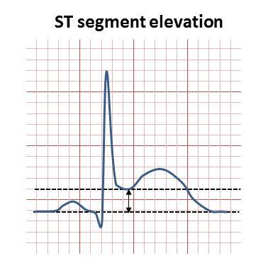 ST elevation - Wikiwand