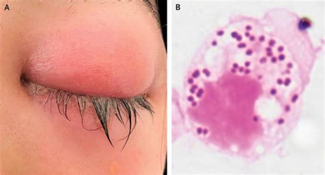 Case of Occular Gonorrhea in 24-Year-Old