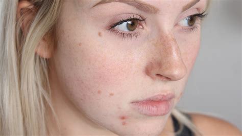 What You Are Doing That May be Causing Acne - Northwest Aesthetics