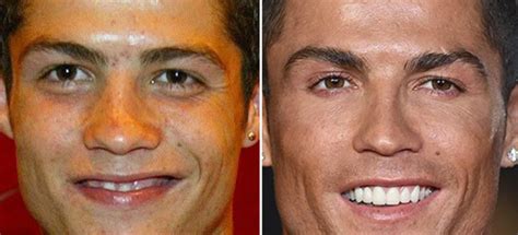 The Truth About Cristiano Ronaldo Plastic Surgeries!