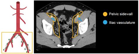 Abdominal CT: lymph nodes • LITFL • Radiology Library