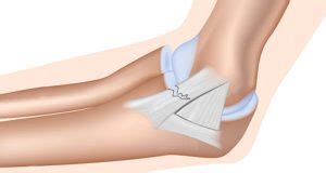 Medial Elbow Ligament Sprain - Symptoms, Causes, Treatment & Rehab