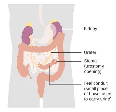 Urostomy | UCSF Ostomy Education Portal