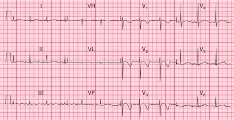 ECG Case 104: Congenital Long QT Syndrome - Manual of Medicine | Flipboard