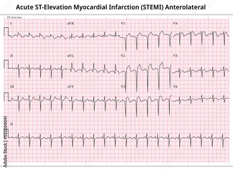 Acute St Elevation Myocardial Infarction | Hot Sex Picture