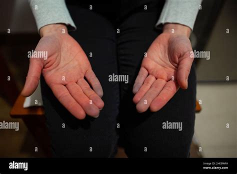 Hands of person with Raynaud syndrome with palms up after attack, affected part turning blue ...