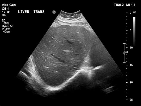 Liver Fibrosis Ultrasound