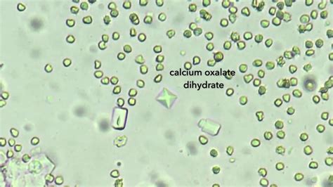 Calcium Oxalate Dihydrate Crystals In Urine