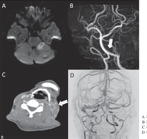 Figure 1 from Lemierre’s syndrome complicated by cerebral infarction: a case report | Semantic ...